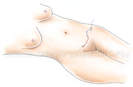 Эндоскопическая абдоминопластика