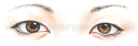 Коррекция азиатского разреза глаз