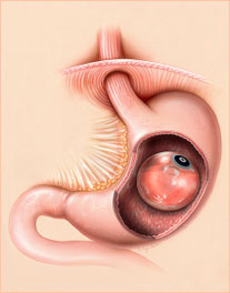 Установка внутрижелудочного баллона