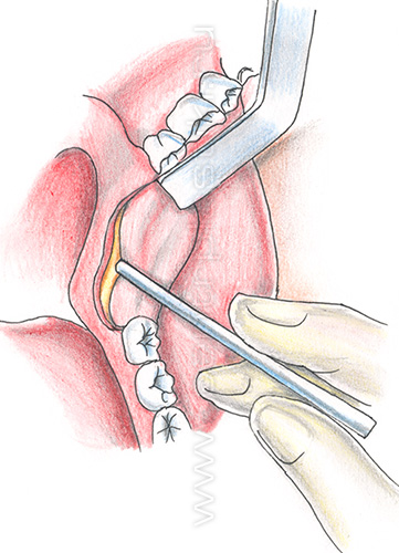 Остеотомия нижней челюсти