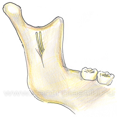 Остеотомия нижней челюсти