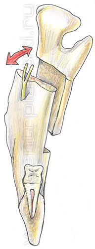 Остеотомия нижней челюсти