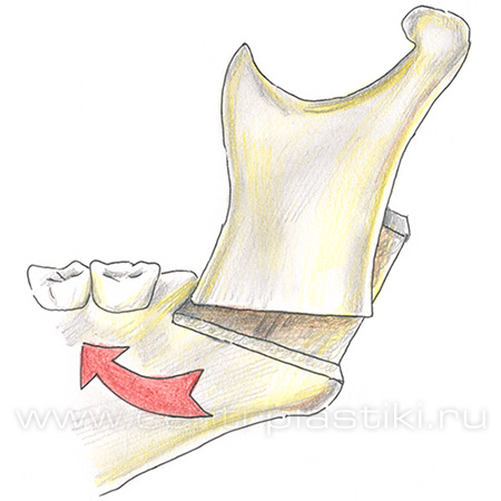 Остеотомия нижней челюсти