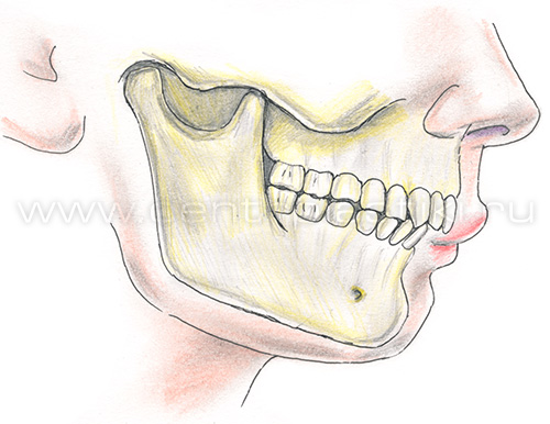 Остеотомия нижней челюсти