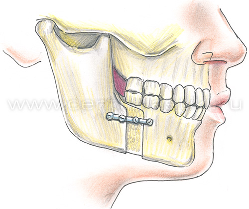 Остеотомия нижней челюсти