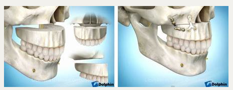 Остеотомия верхней челюсти