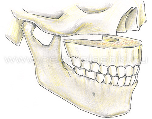 Остеотомия верхней челюсти