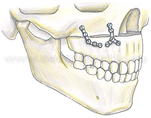 Остеотомия верхней челюсти