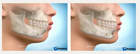 Гениопластика