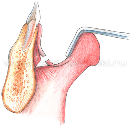 Гениопластика