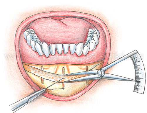 Гениопластика