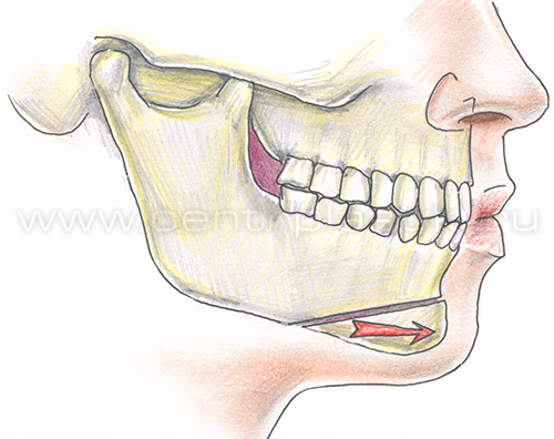 Гениопластика