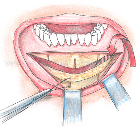 Гениопластика