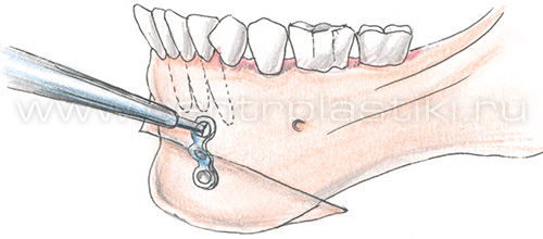 Гениопластика
