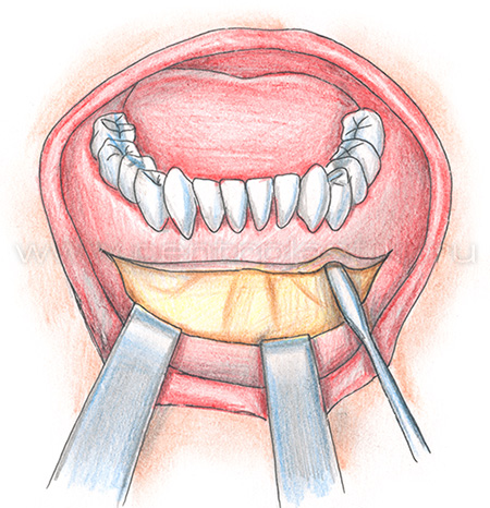 Гениопластика