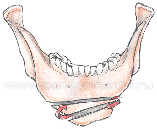 Гениопластика