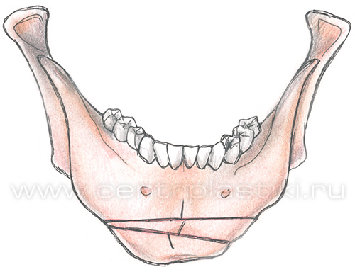 Гениопластика