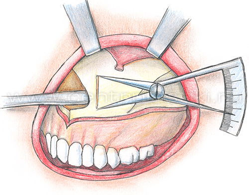 Секторальная остеотомия фронтального отдела верхней челюсти