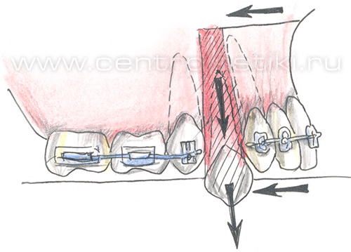 Секторальная остеотомия фронтального отдела верхней челюсти