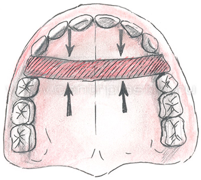 Секторальная остеотомия фронтального отдела верхней челюсти