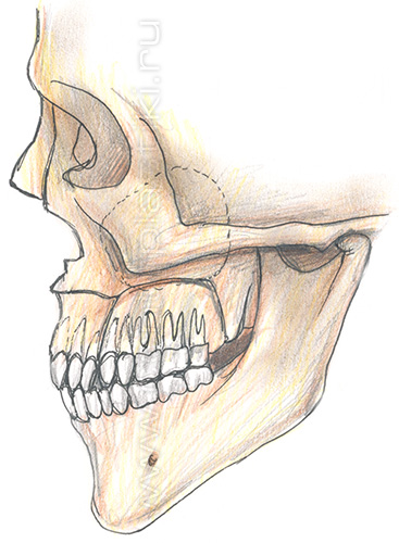 Секторальная остеотомия латерального отдела верхней челюсти