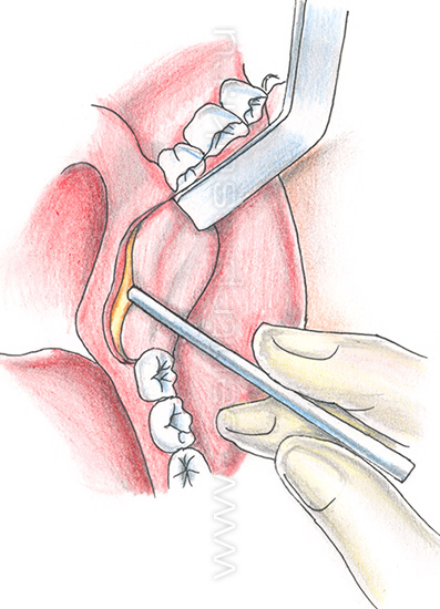 Пластика челюсти