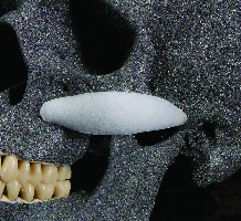 Увеличение проекции средней зоны лица имплантами