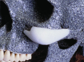 Увеличение проекции средней зоны лица имплантами