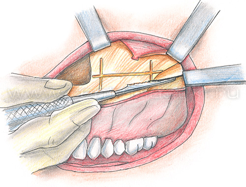 Изменение формы параорбитальной области имплантами