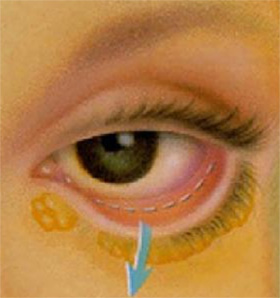 Изменение формы параорбитальной области имплантами