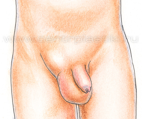 Паховая грыжа у мальчика