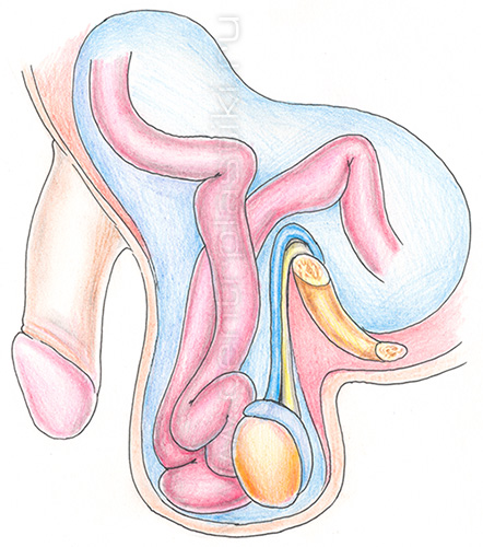 Паховая грыжа у мальчика