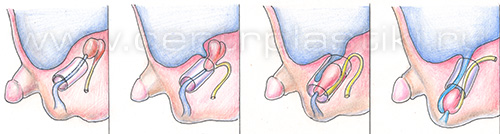 Паховая грыжа у детей