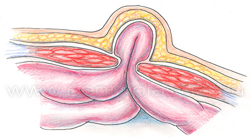 Пупочная грыжа у детей