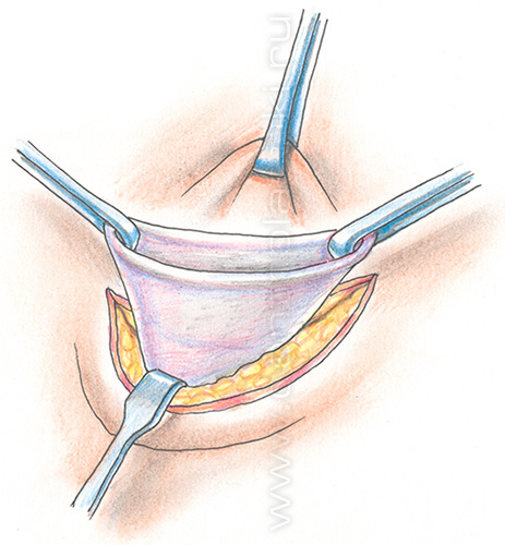 Пупочная грыжа у детей
