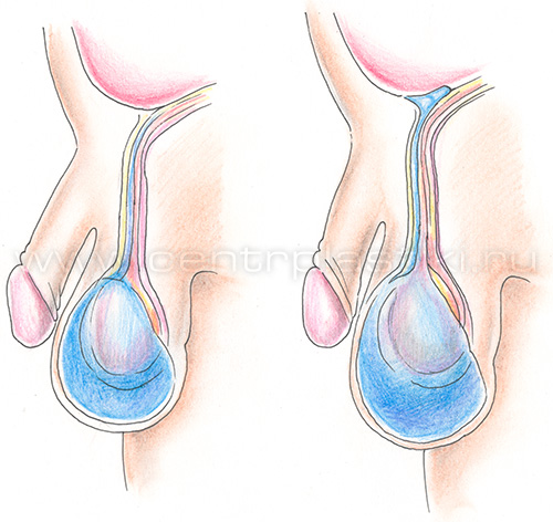 Водянка яичка