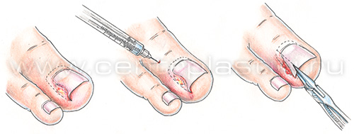 Вросший ноготь у ребенка, удаление
