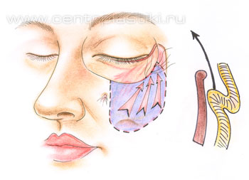 Операции на веках