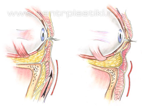 Операции на веках