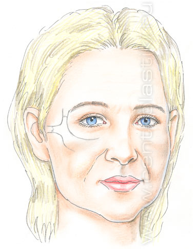 Эндоскопическая подтяжка лица