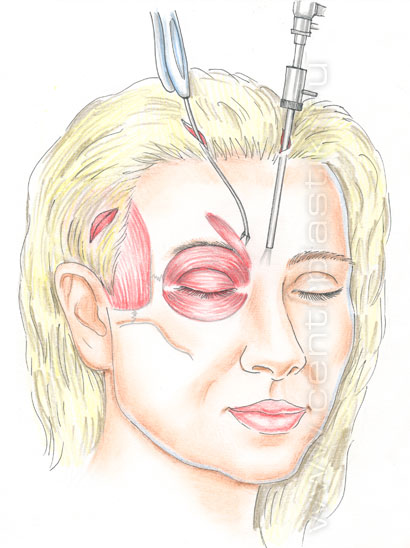 Эндоскопическая подтяжка лица