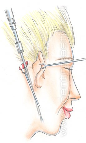 Эндоскопическая подтяжка лица