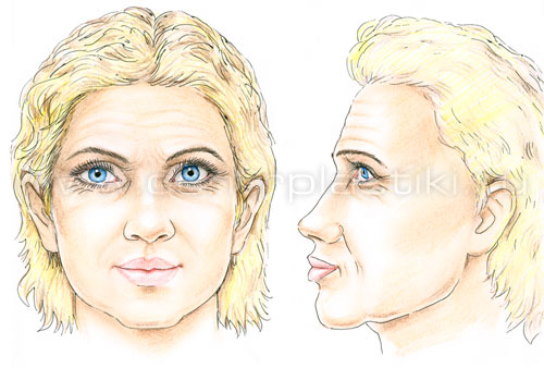 Эндоскопическая подтяжка лба и бровей