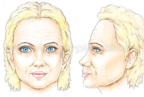 Эндоскопическая подтяжка лба и бровей