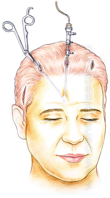 Эндоскопическая подтяжка лба и бровей