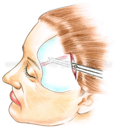 Эндоскопическая подтяжка лба и бровей