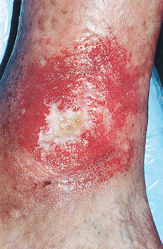 Трофическая язва