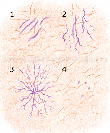 Сосудистые звездочки