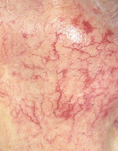 Сосудистые звездочки