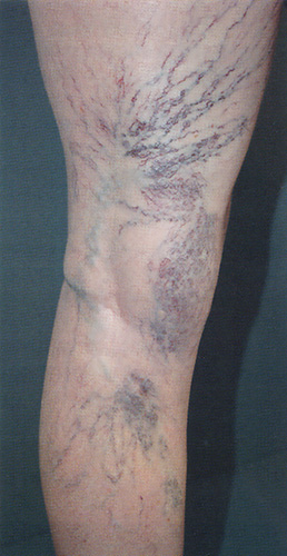 Сосудистые звездочки